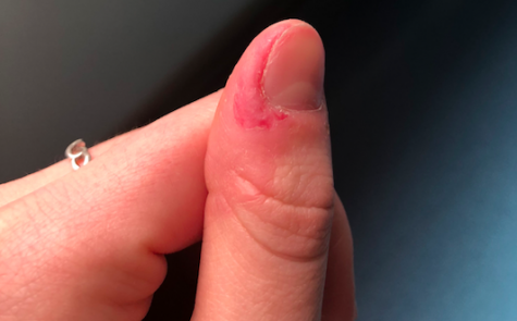 Paronychia: acute and chronic (nail disease, felon/whitlow) - Dermatology  Advisor